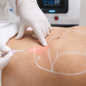 Endolift Endolaser Laserlift Endolipolyse Laserlipolyse Laserfaser Minimalinvasiv