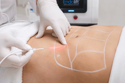 Endolift Endolaser Laserlift Endolipolyse Laserlipolyse Laserfaser Minimalinvasiv