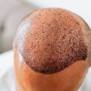 Haartransplantation nach FUE DHI FUT