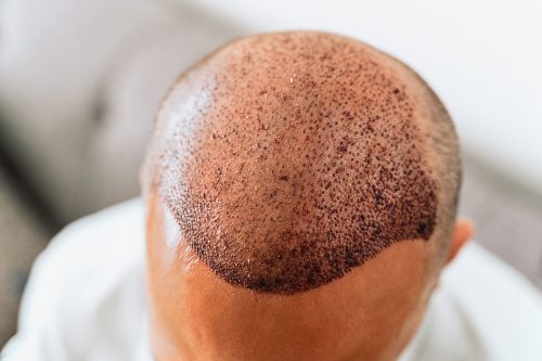 Haartransplantation nach FUE DHI FUT