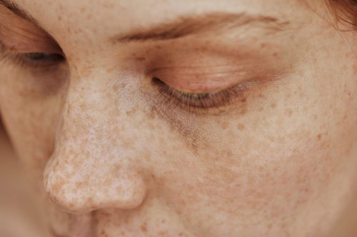 Pigmentstörungen / Pigmentflecken Pico Laser