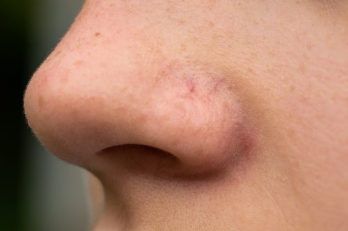 Couperose, Rosacea , Äderchen, Besenreiser : Gefäßlaser für Gesicht & Körper