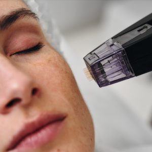 Microneedling Medicalneedling