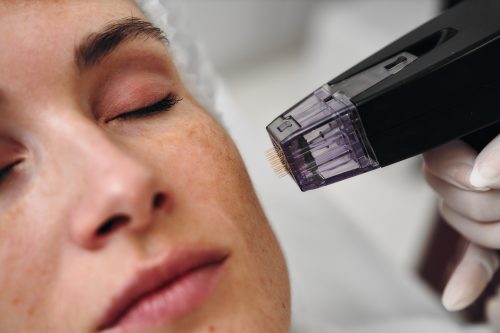 Microneedling Medicalneedling