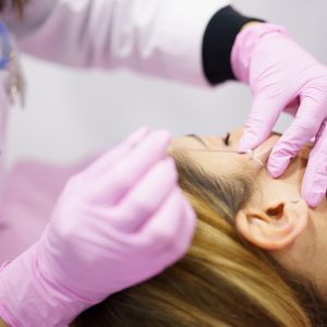 Widerhakenfäden werden präzise platziert, Kollagenbildung- Facelifting für Hängebäckchen Lifting am Gesicht & Körper mit Fäden ohne Operation