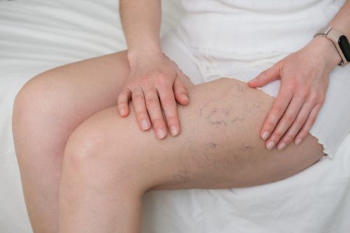 Couperose, Rosacea , Äderchen, Besenreiser : Gefäßlaser für Gesicht & Körper